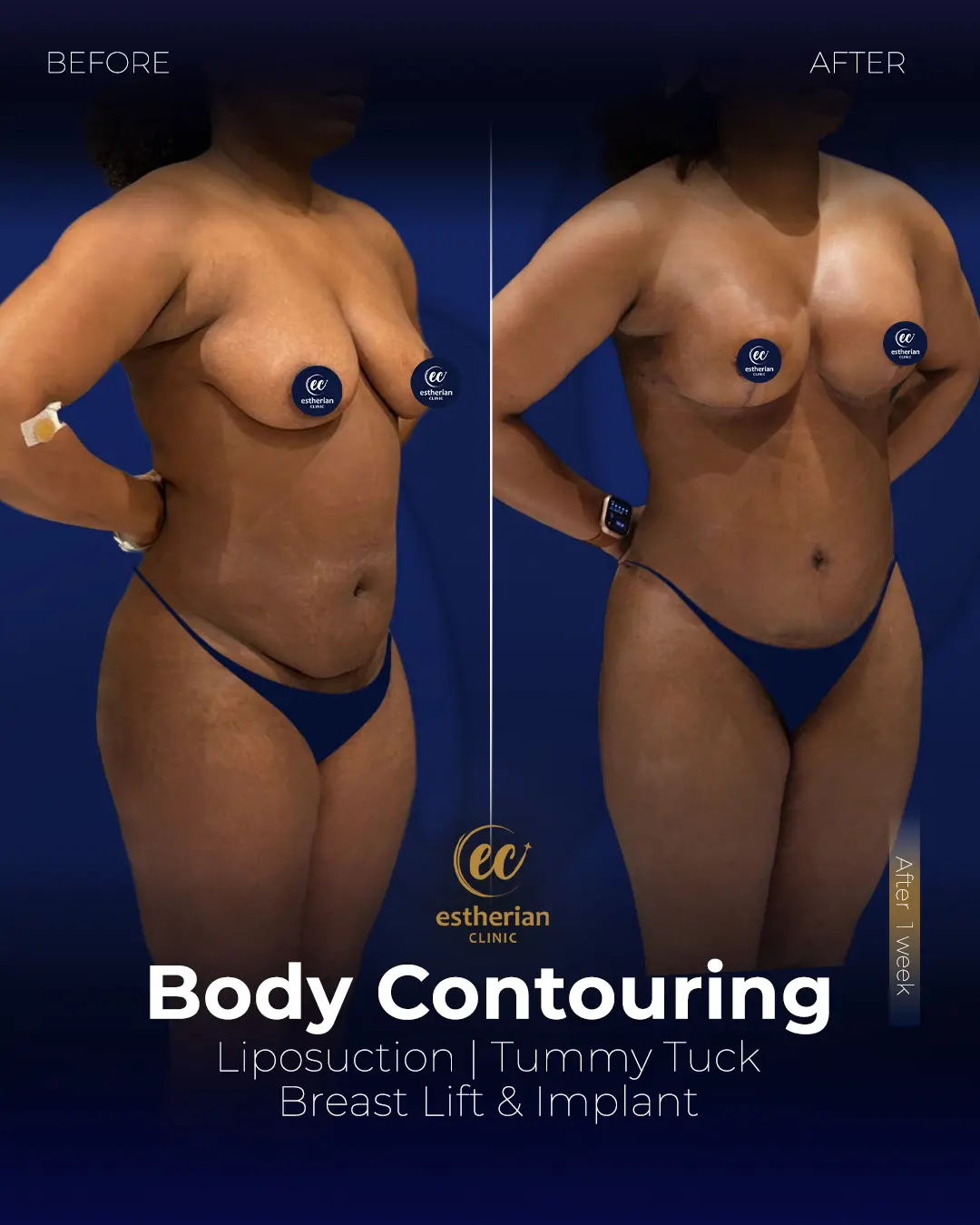 Body Contouring Surgery (before and after) by the Estherian Clinic