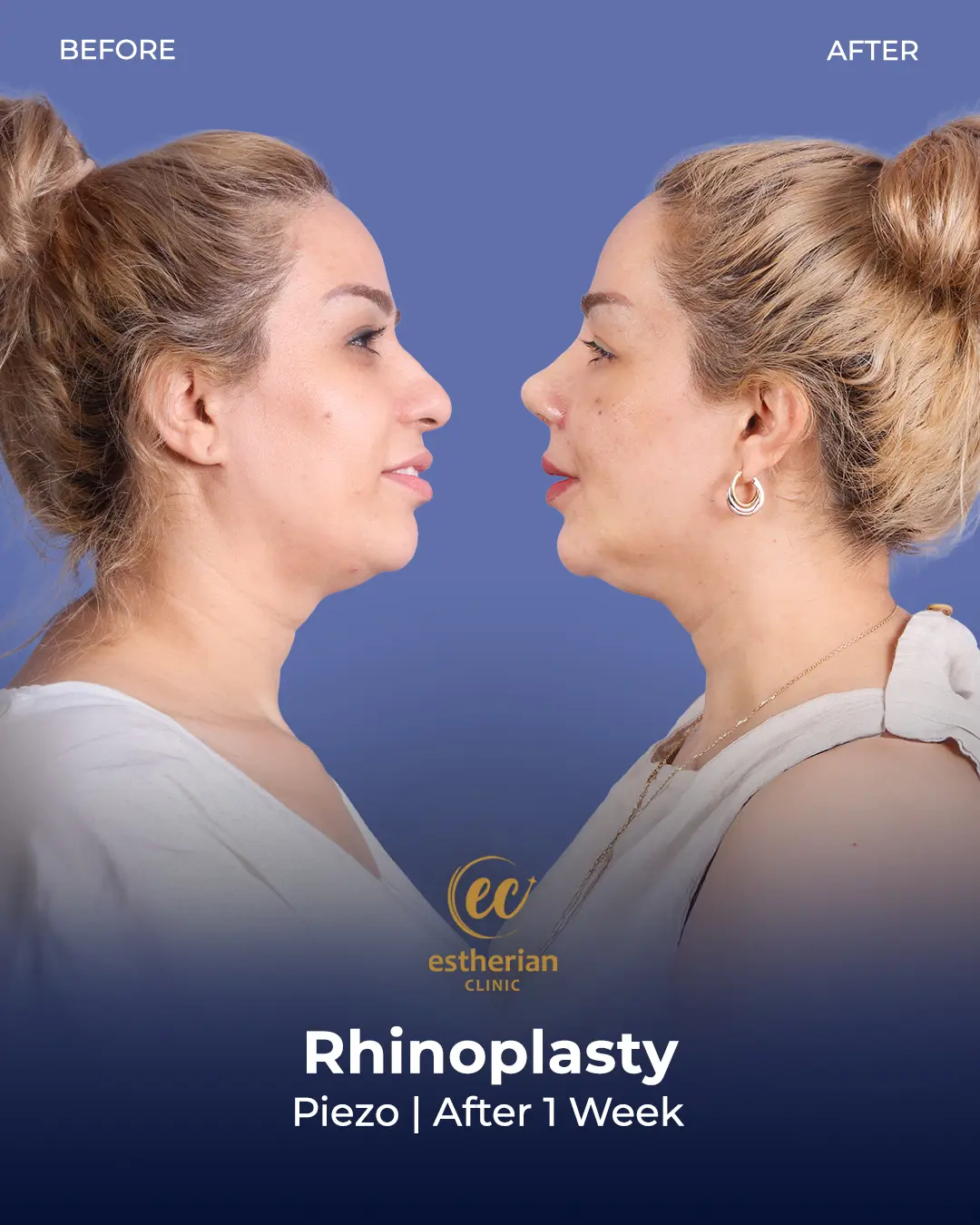 Rhinoplasty Before and After by the Estherian Clinic