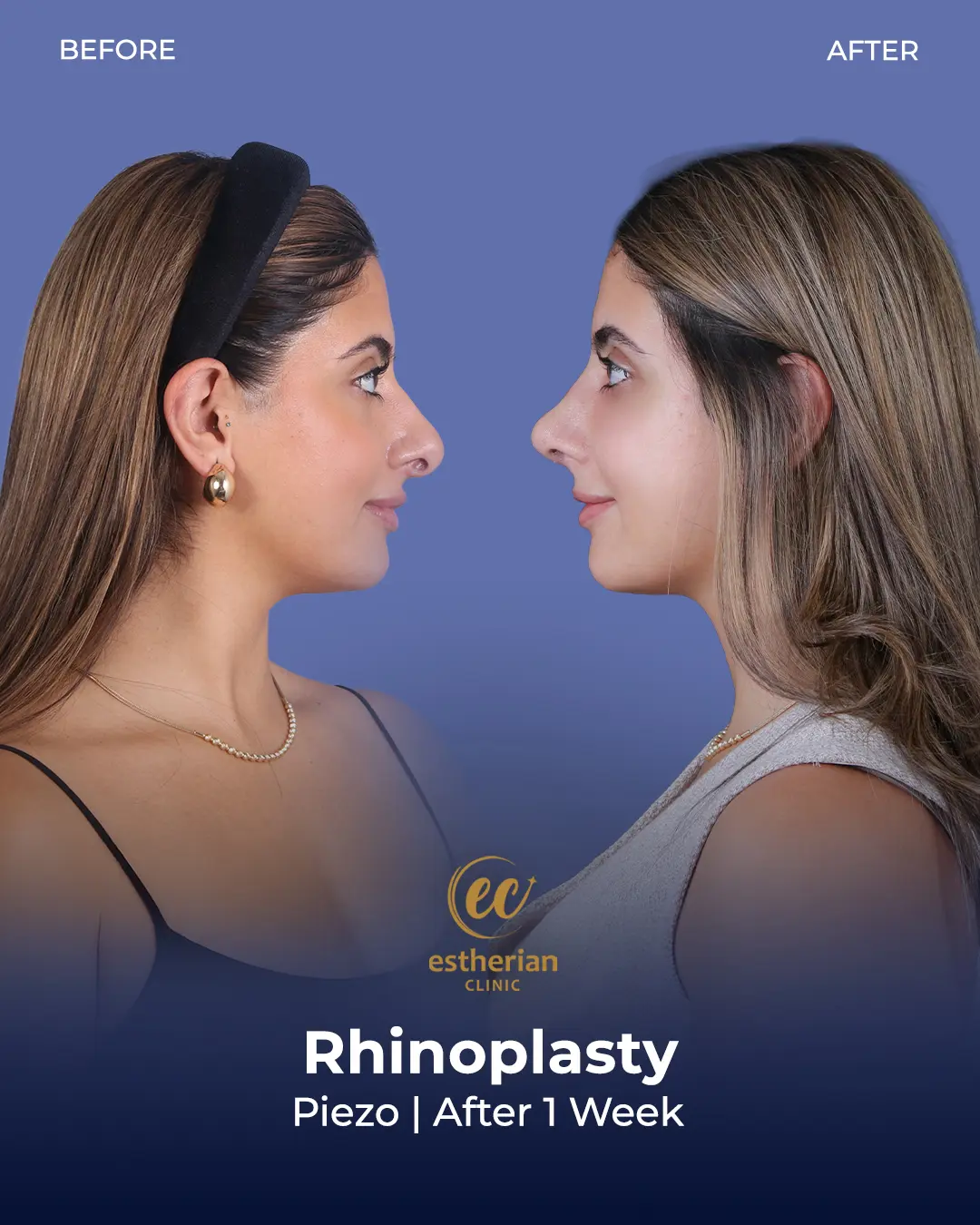 Rhinoplasty Before and After by the Estherian Clinic