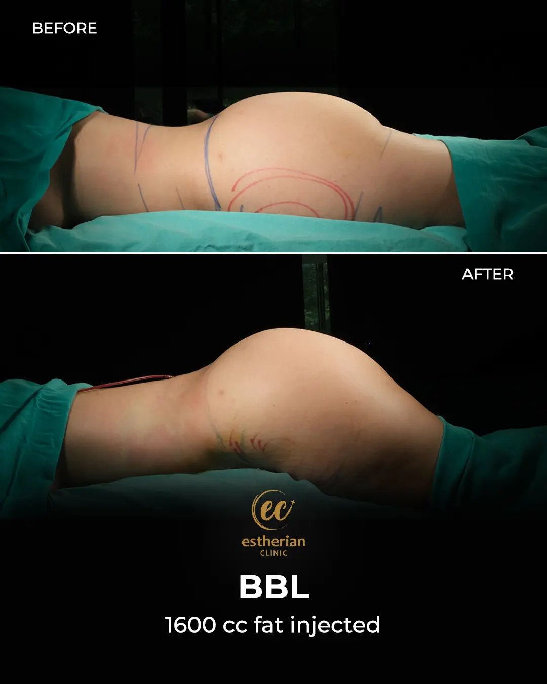 BBL - Brazilian Butt Lift Results by the Estherian Clinic