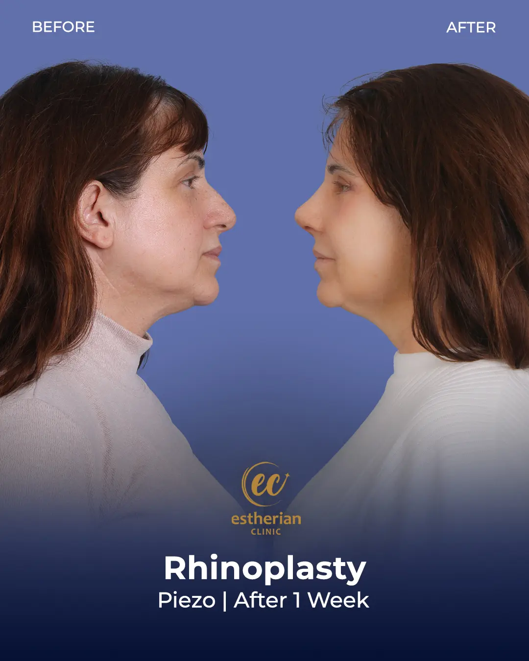 Rhinoplasty Before and After by the Estherian Clinic
