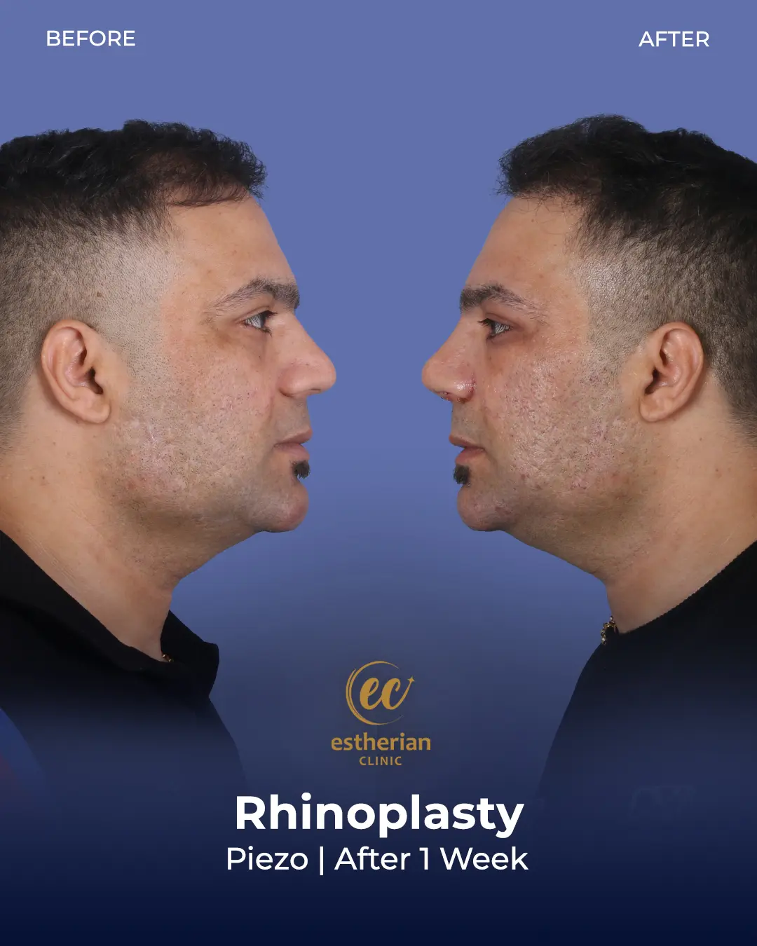 Rhinoplasty Before and After by the Estherian Clinic
