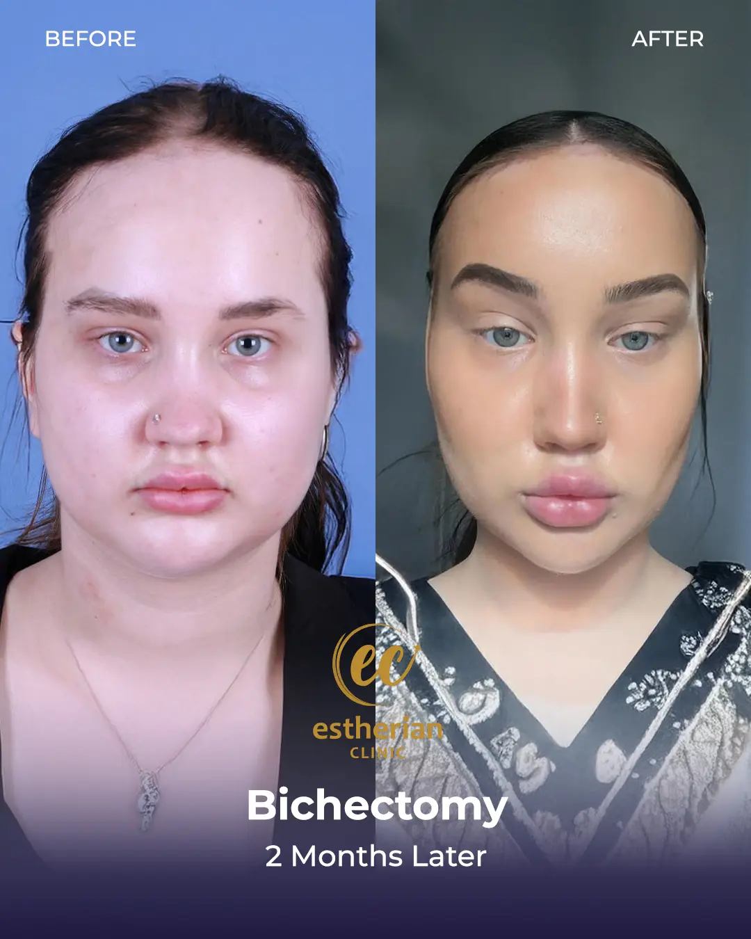 Bichectomy Before and after by the Estherian Clinic