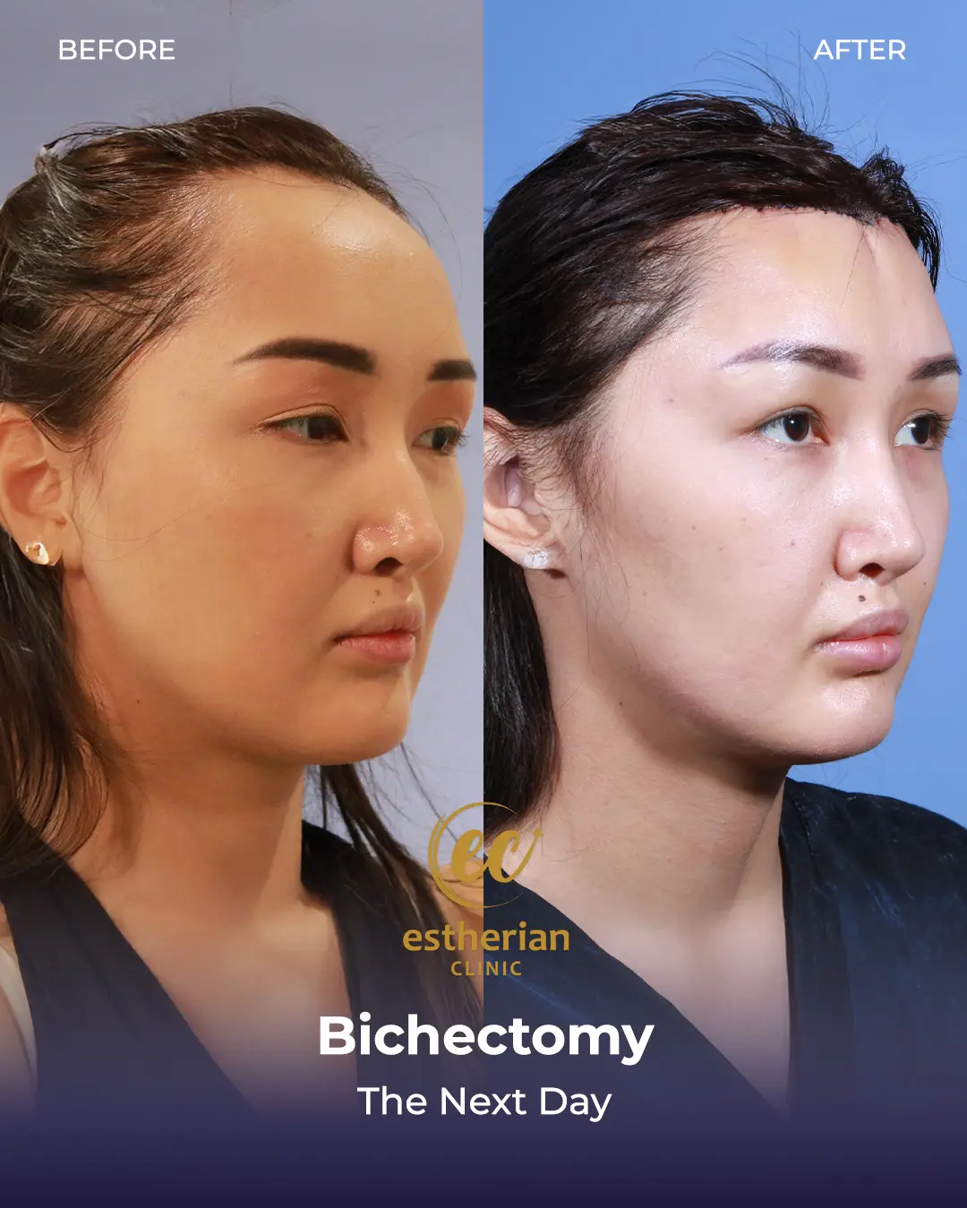 Bichectomy Before and after by the Estherian Clinic