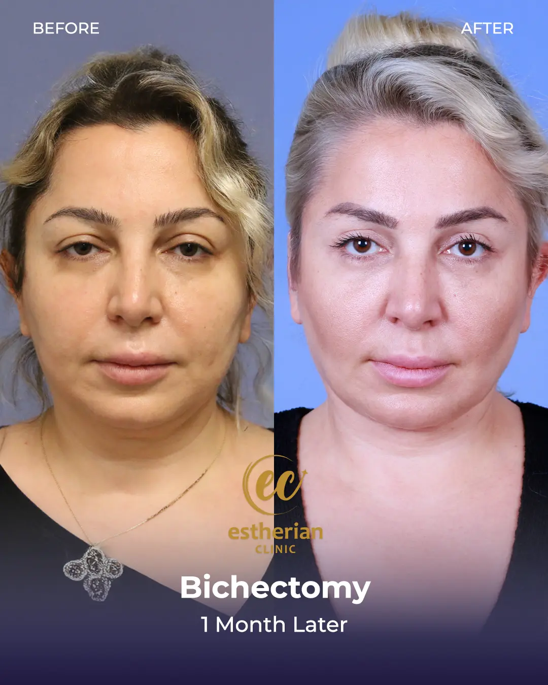 Bichectomy Before and after by the Estherian Clinic