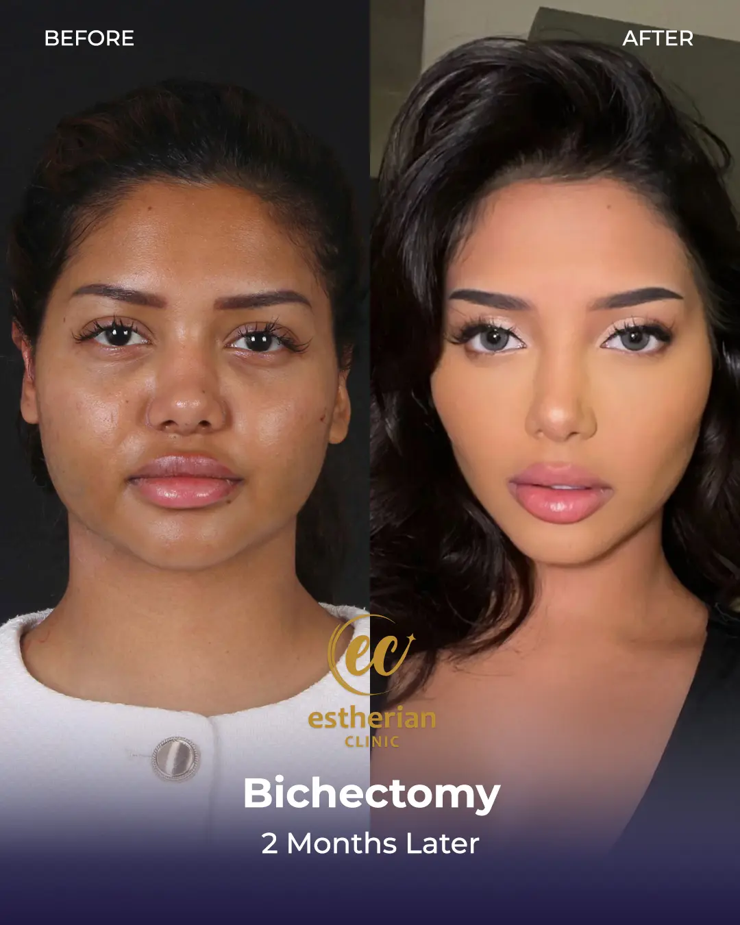 Bichectomy Before and after by the Estherian Clinic