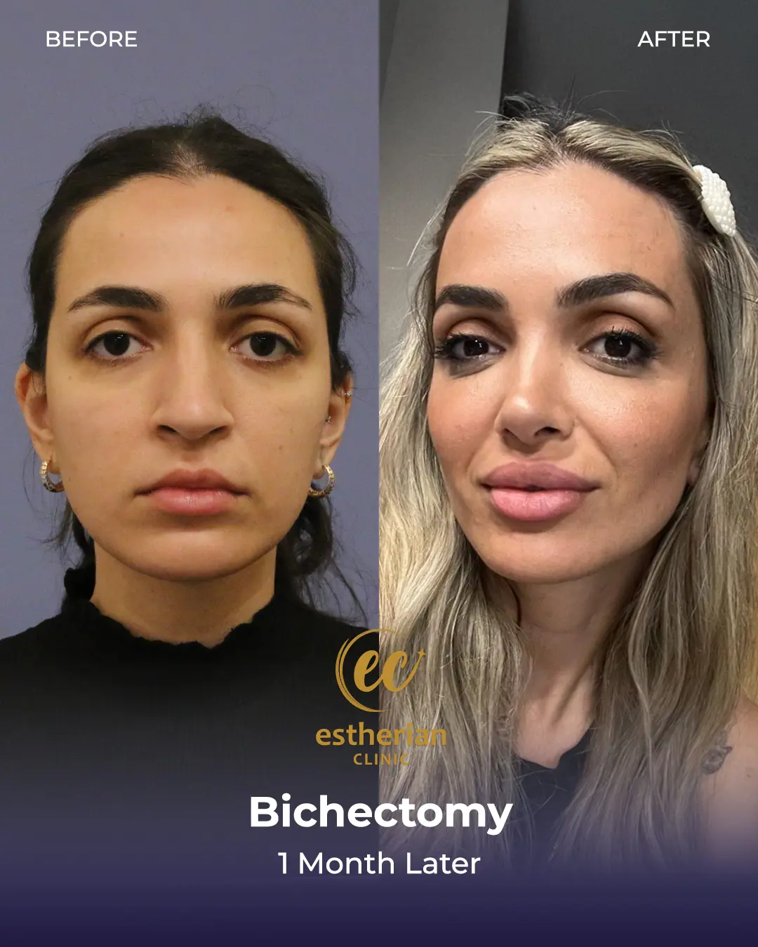 Bichectomy Before and after by the Estherian Clinic