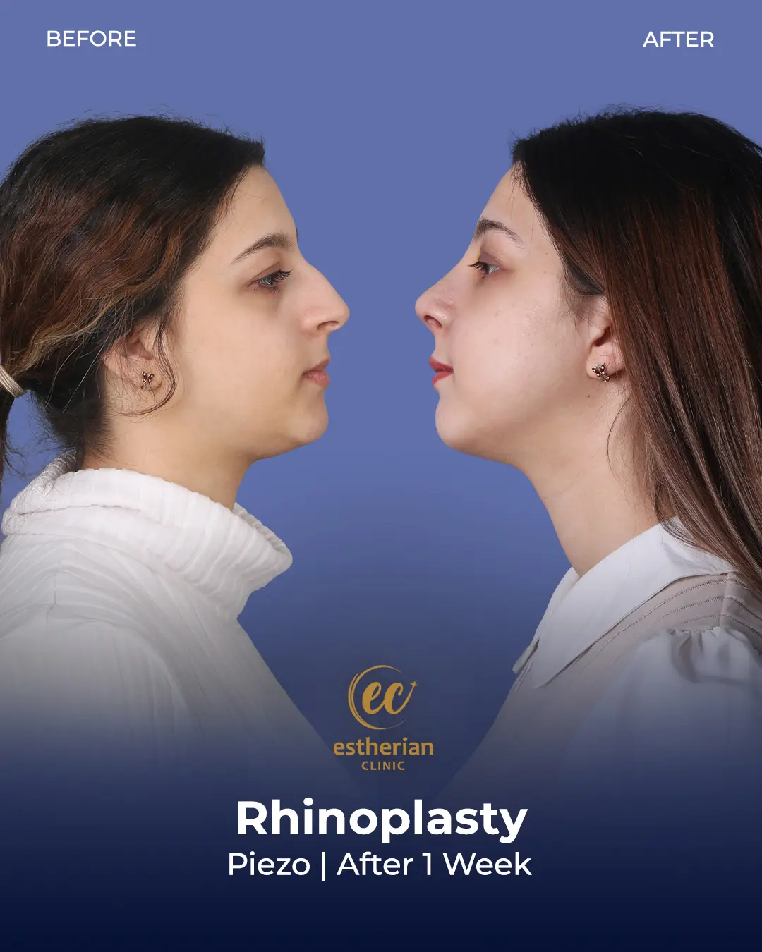 Rhinoplasty Before and After by the Estherian Clinic