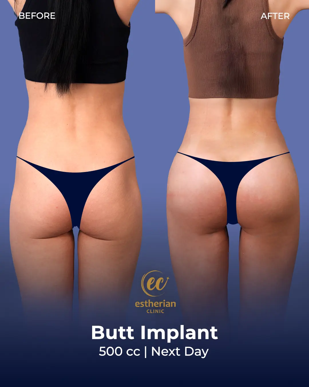Butt Implant Before-and-after Patient Transformation by the Estherian Clinic