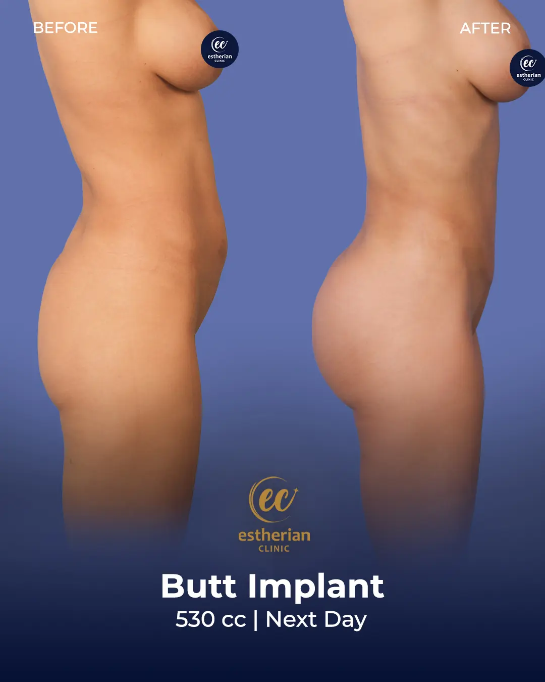 Butt Implant Before-and-after Patient Transformation by the Estherian Clinic