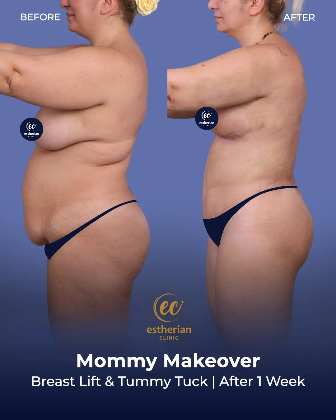 Body Contouring Surgery (before and after) by the Estherian Clinic