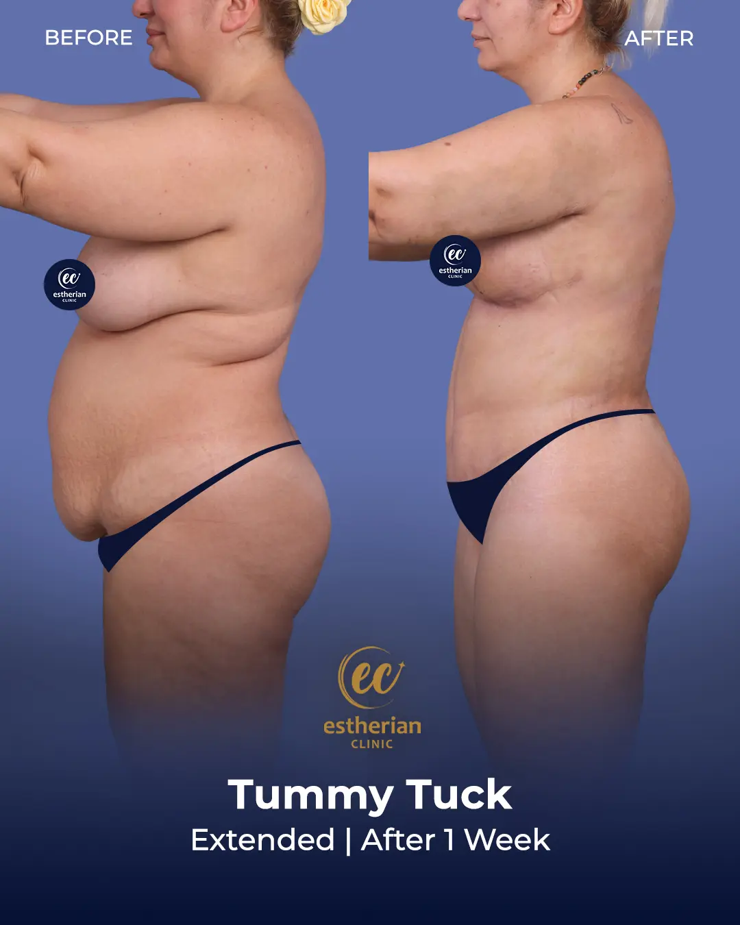 Tummy Tuck Before and after by the Estherian Clinic