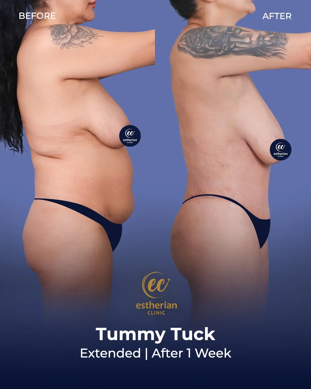 Tummy Tuck Before and after by the Estherian Clinic