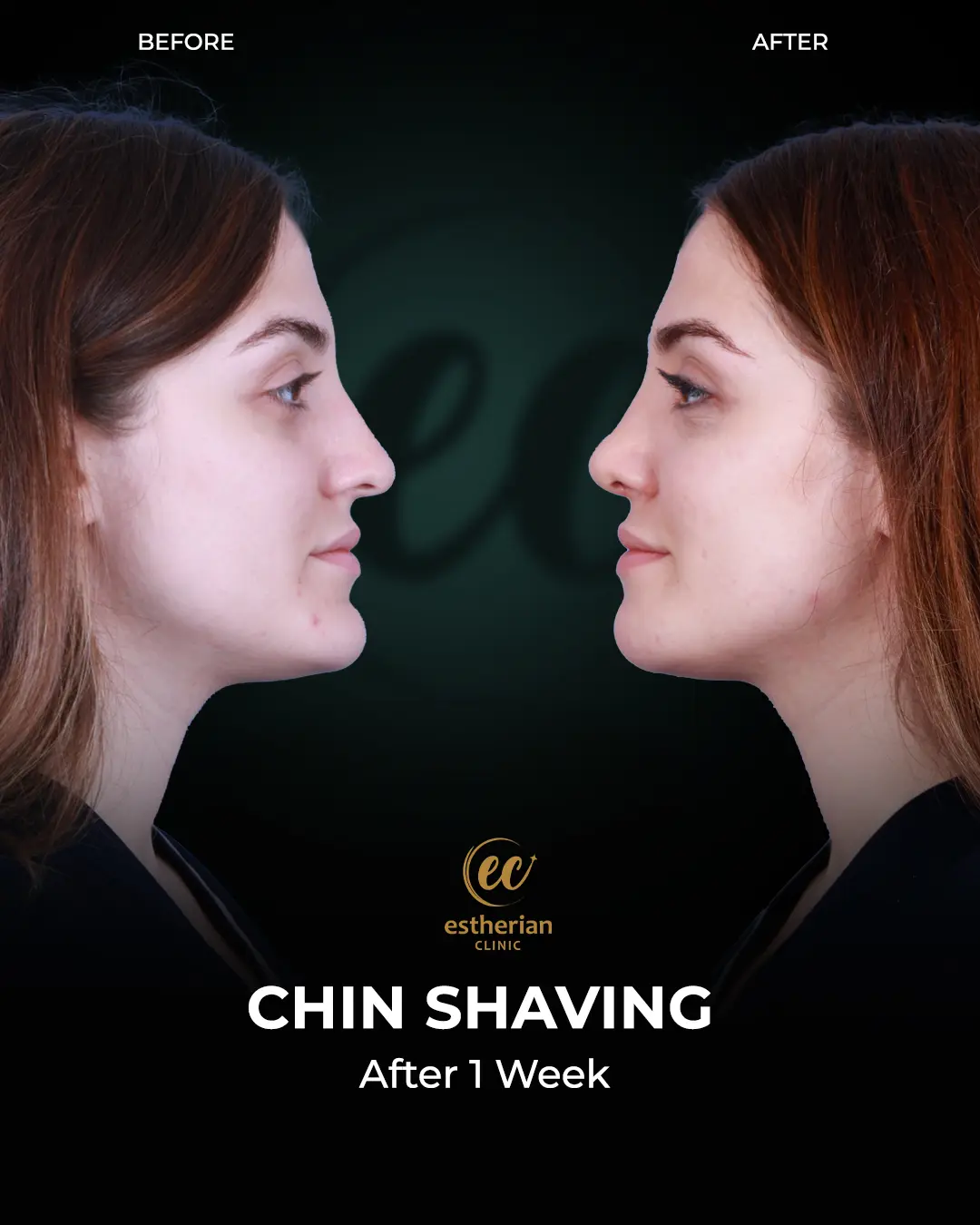 Real Patient Transformation (Chin Shaving) before-and-after by the Estherian Clinic
