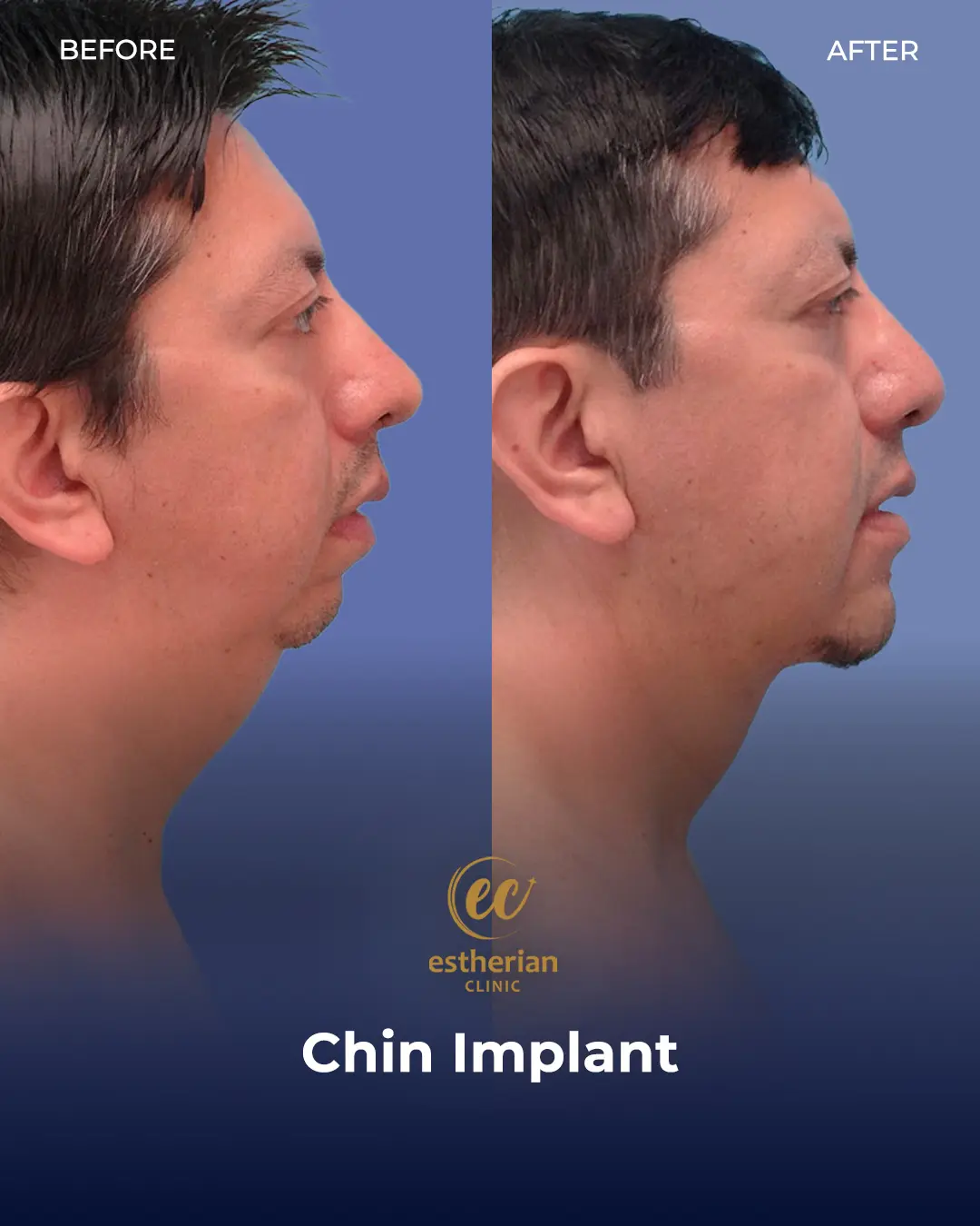 Chin Implant Before and after by the Estherian Clinic