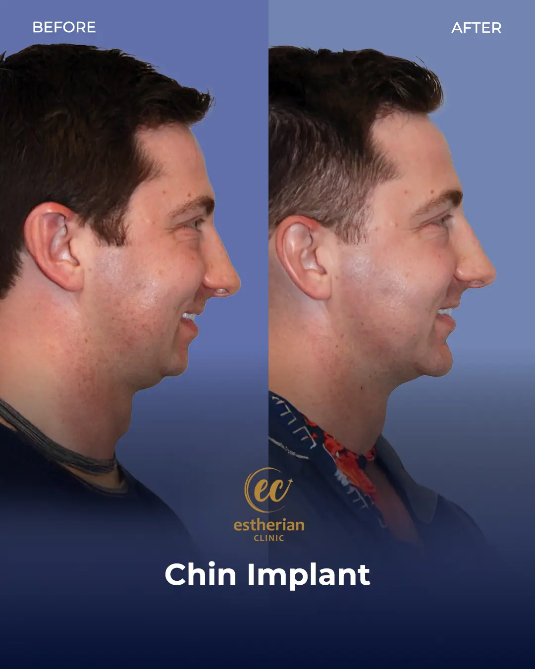 Chin Implant Before and after by the Estherian Clinic