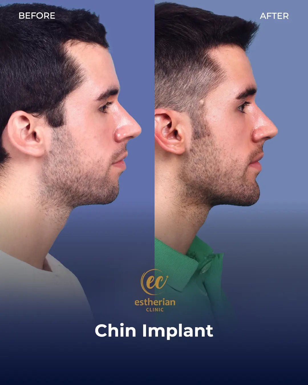 Chin Implant Before and after by the Estherian Clinic