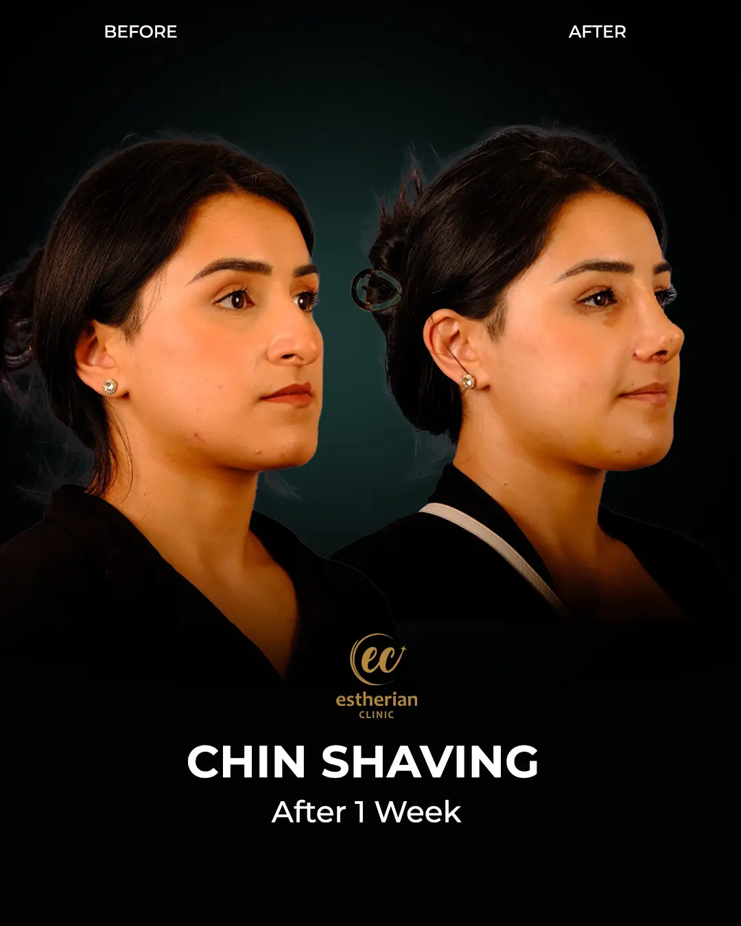 Real Patient Transformation (Chin Shaving) before-and-after by the Estherian Clinic