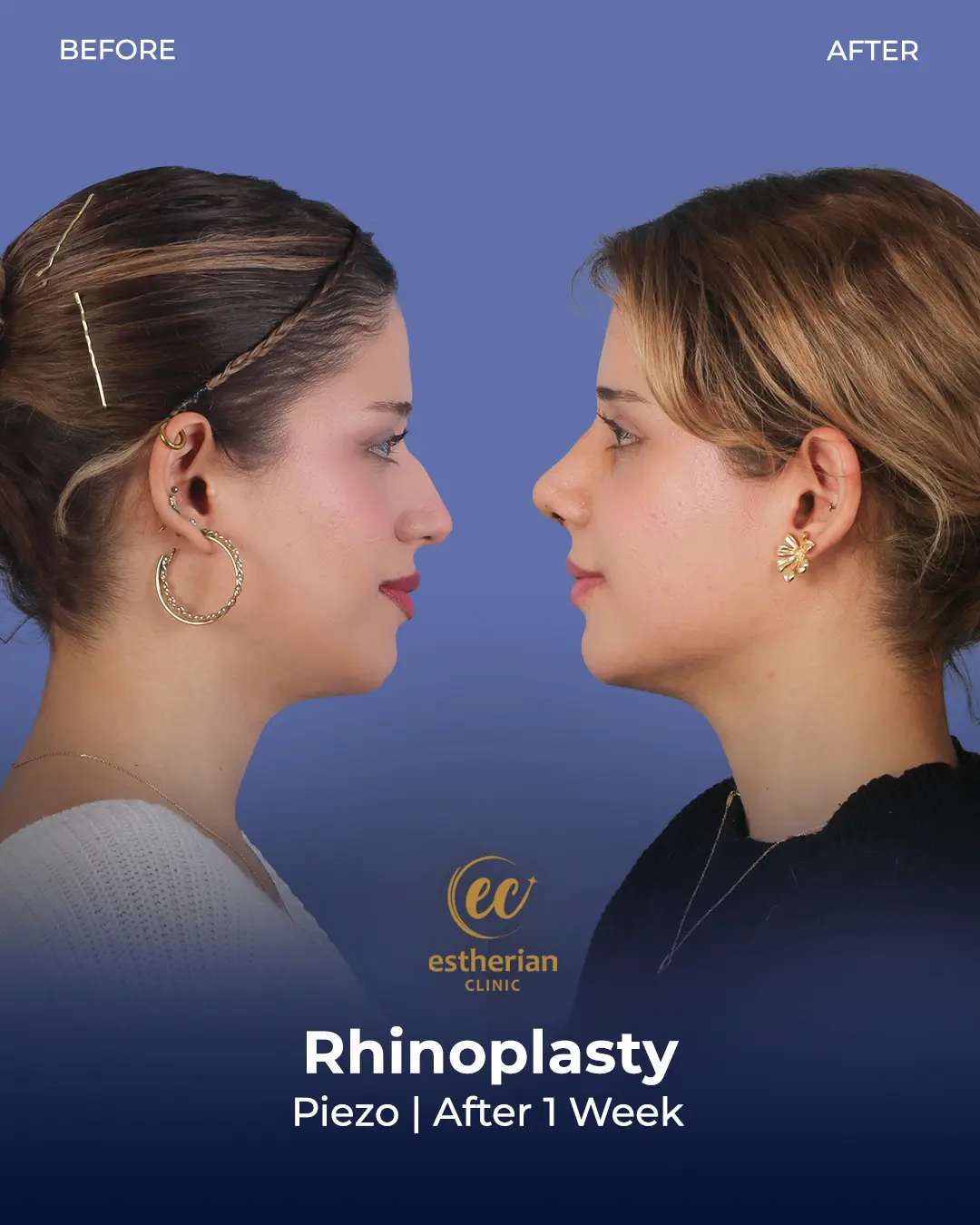 Rhinoplasty Before and After by the Estherian Clinic