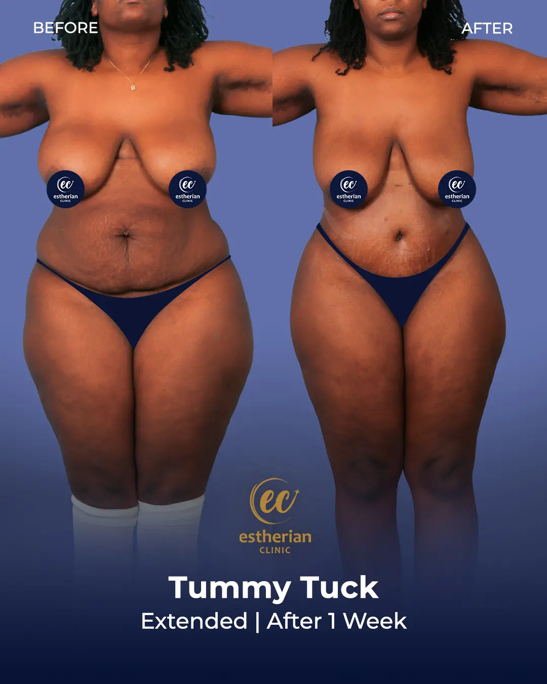 Tummy Tuck Before and after by the Estherian Clinic
