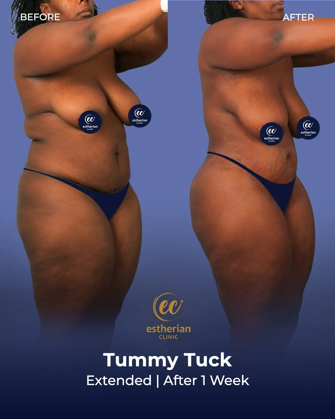 Tummy Tuck Before and after by the Estherian Clinic