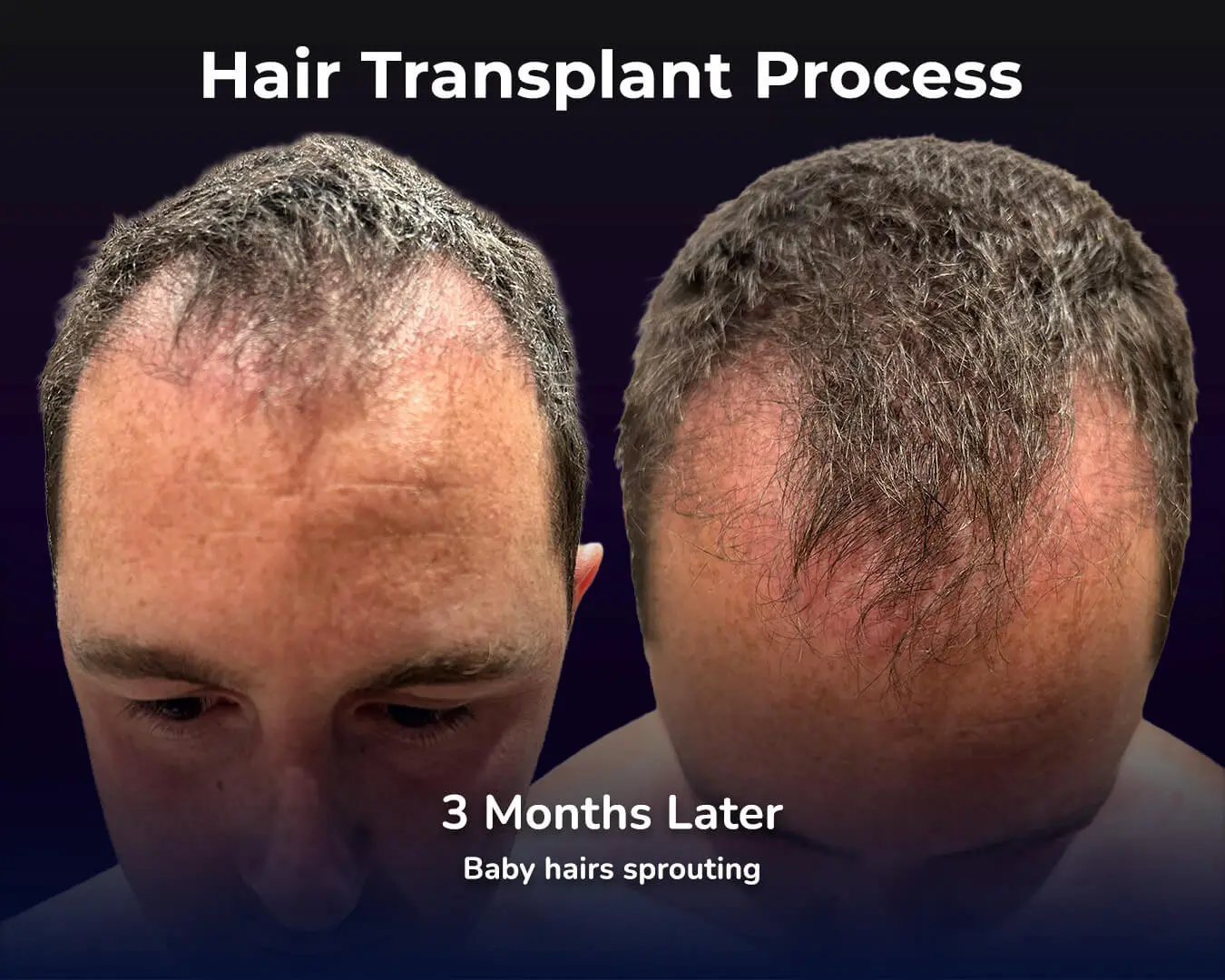 DHI hair transplant Recovery Process - 3 Months Progress