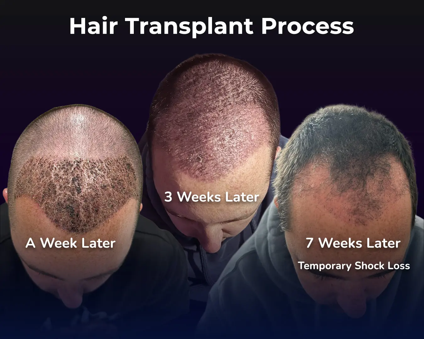 DHI hair transplant Recovery Process - Real Patient Case Study