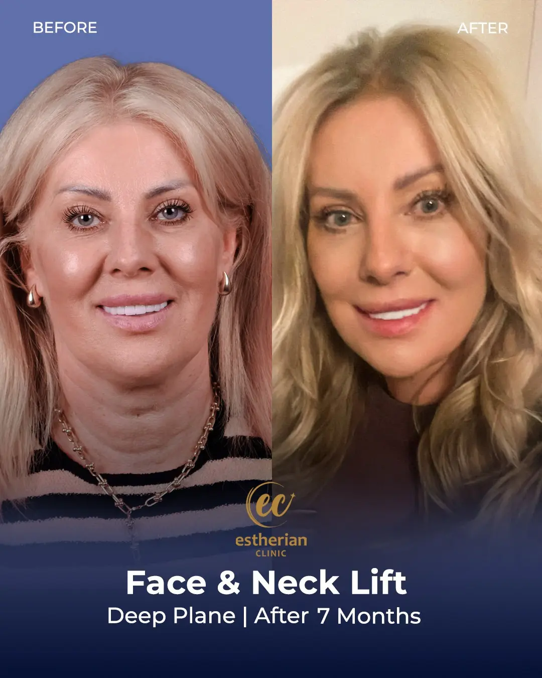 Face and Neck Lift Before and After Gallery by the Estherian Clinic