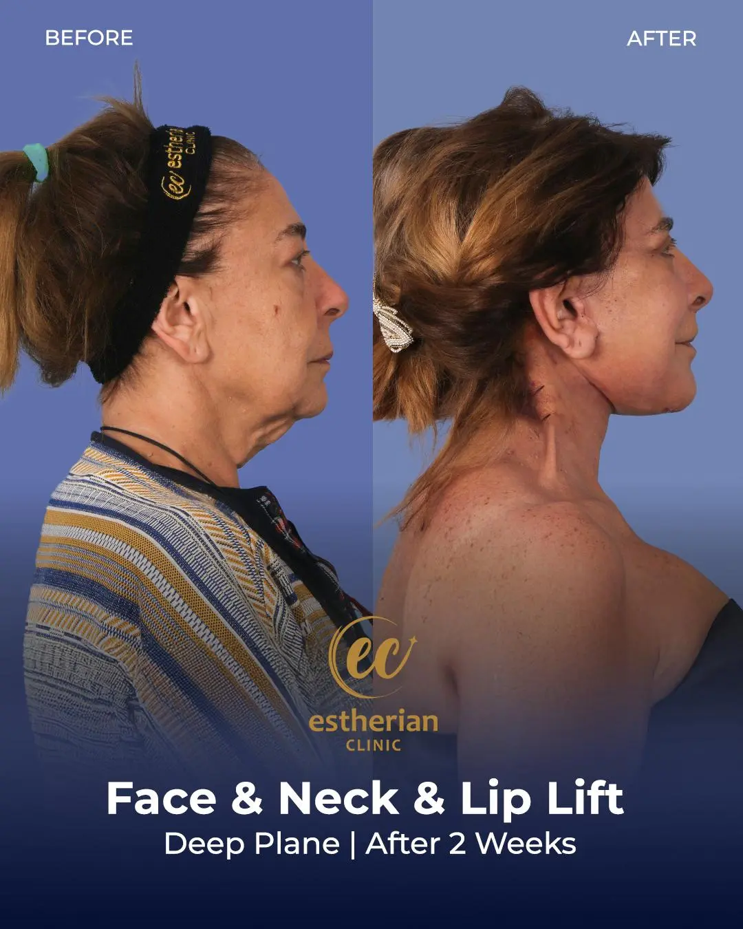 Face and Neck Lift Before and After Gallery by the Estherian Clinic