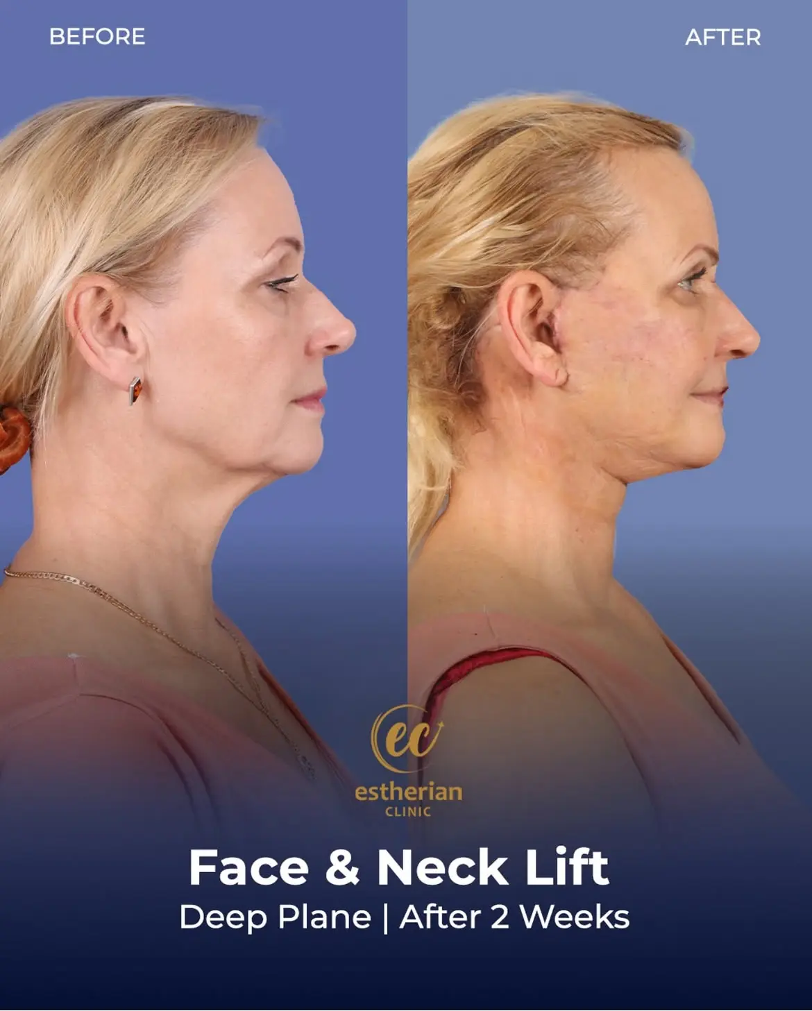 Face and Neck Lift Before and After Gallery by the Estherian Clinic