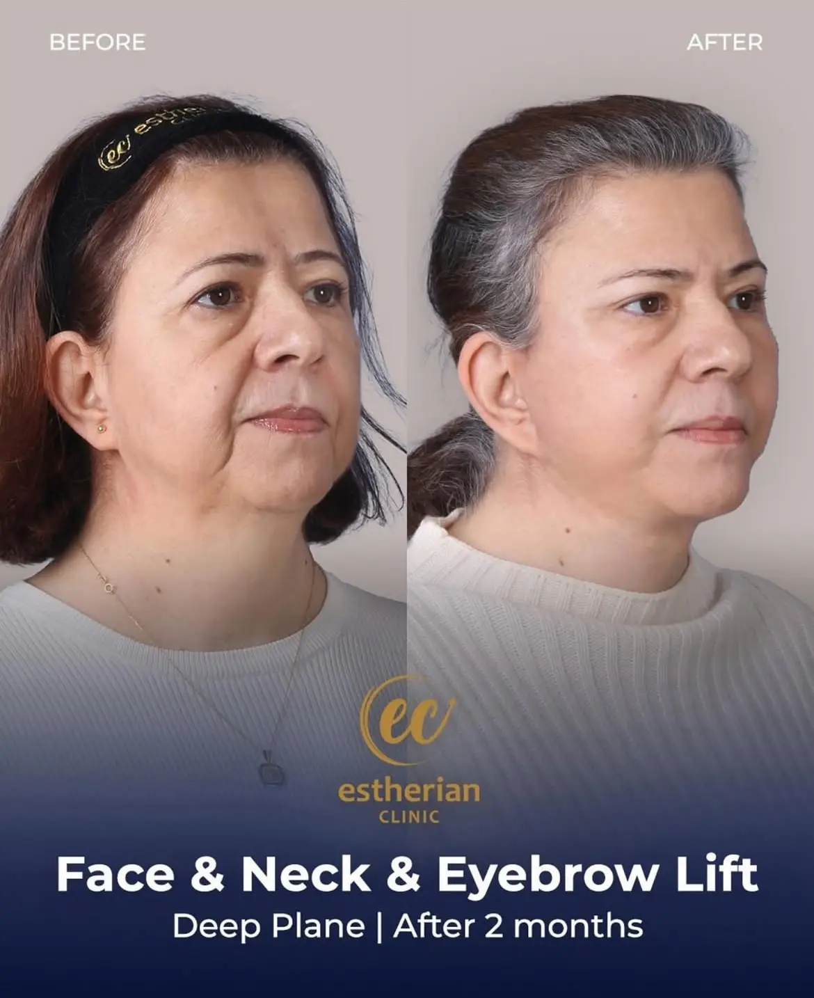 Face and Neck Lift Before and After Gallery by the Estherian Clinic