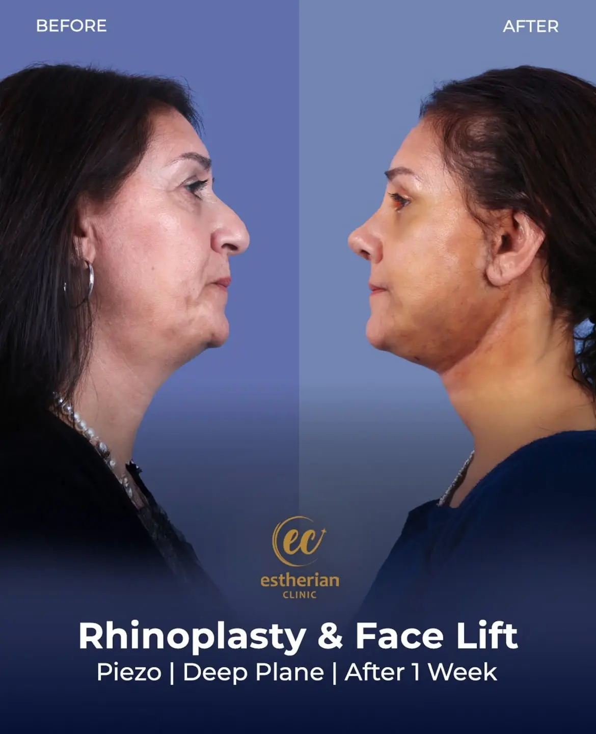 Face and Neck Lift Before and After Gallery by the Estherian Clinic