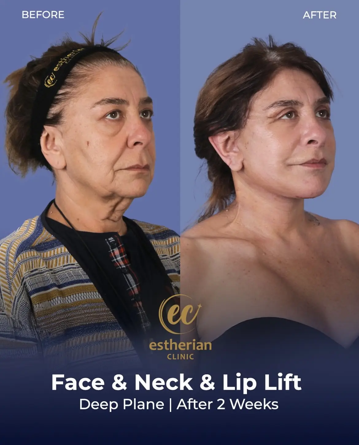 Face and Neck Lift Before and After Gallery by the Estherian Clinic