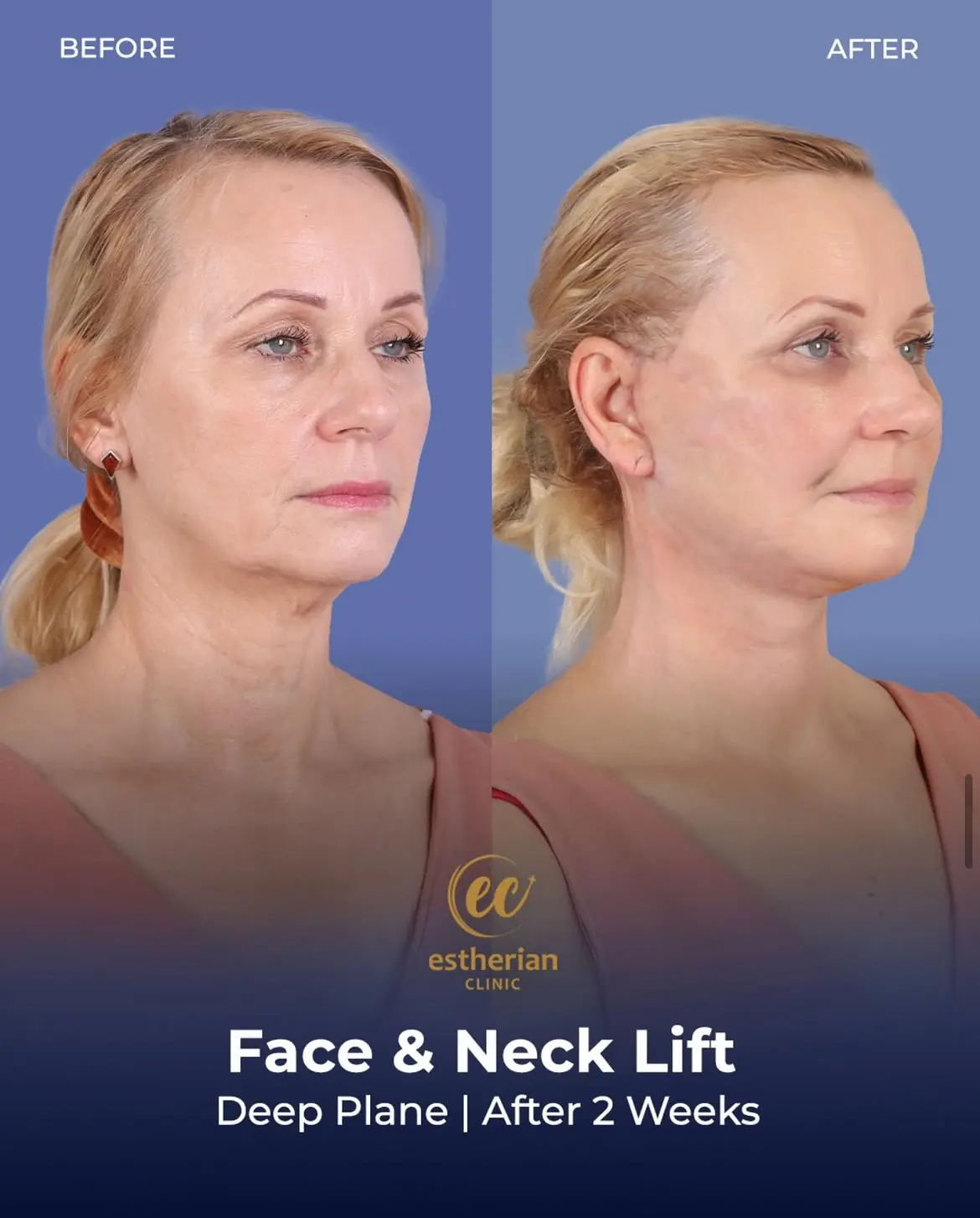 Face and Neck Lift Before and After Gallery by the Estherian Clinic