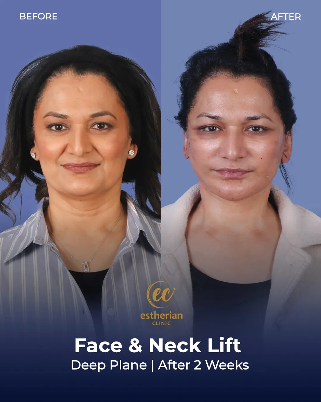 Face and Neck Lift Before and After Gallery by the Estherian Clinic