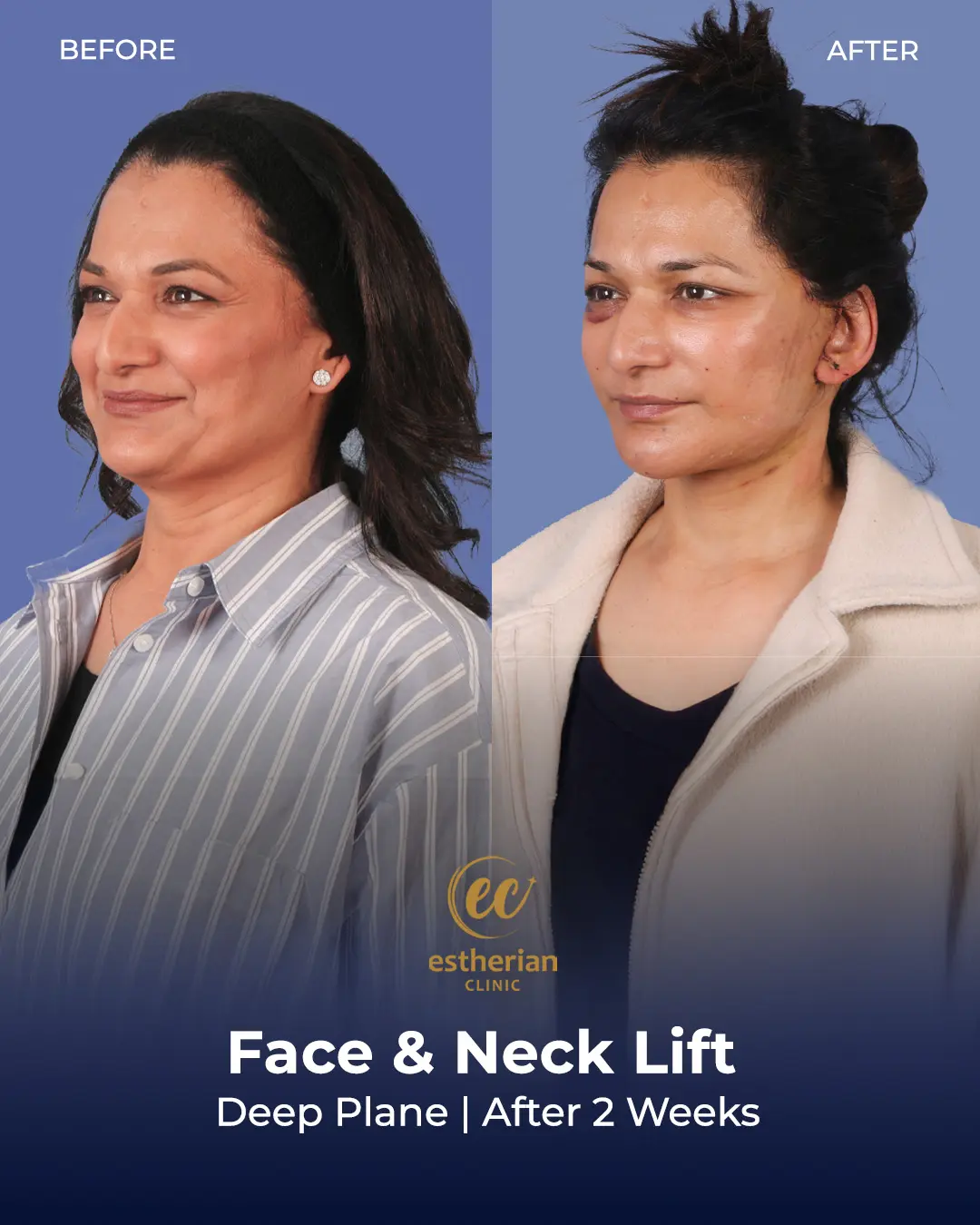Face and Neck Lift Before and After Gallery by the Estherian Clinic