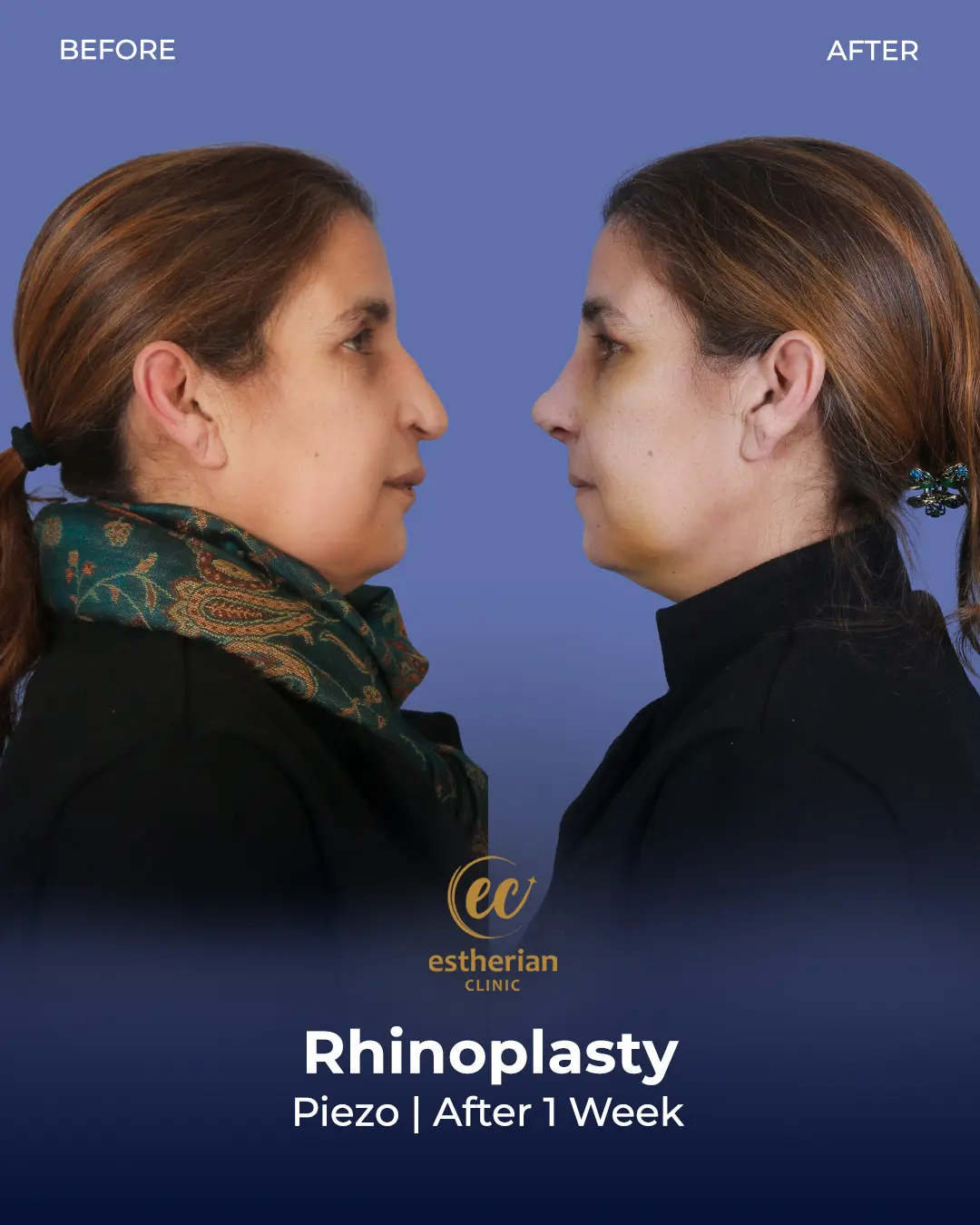 Rhinoplasty Before and After by the Estherian Clinic