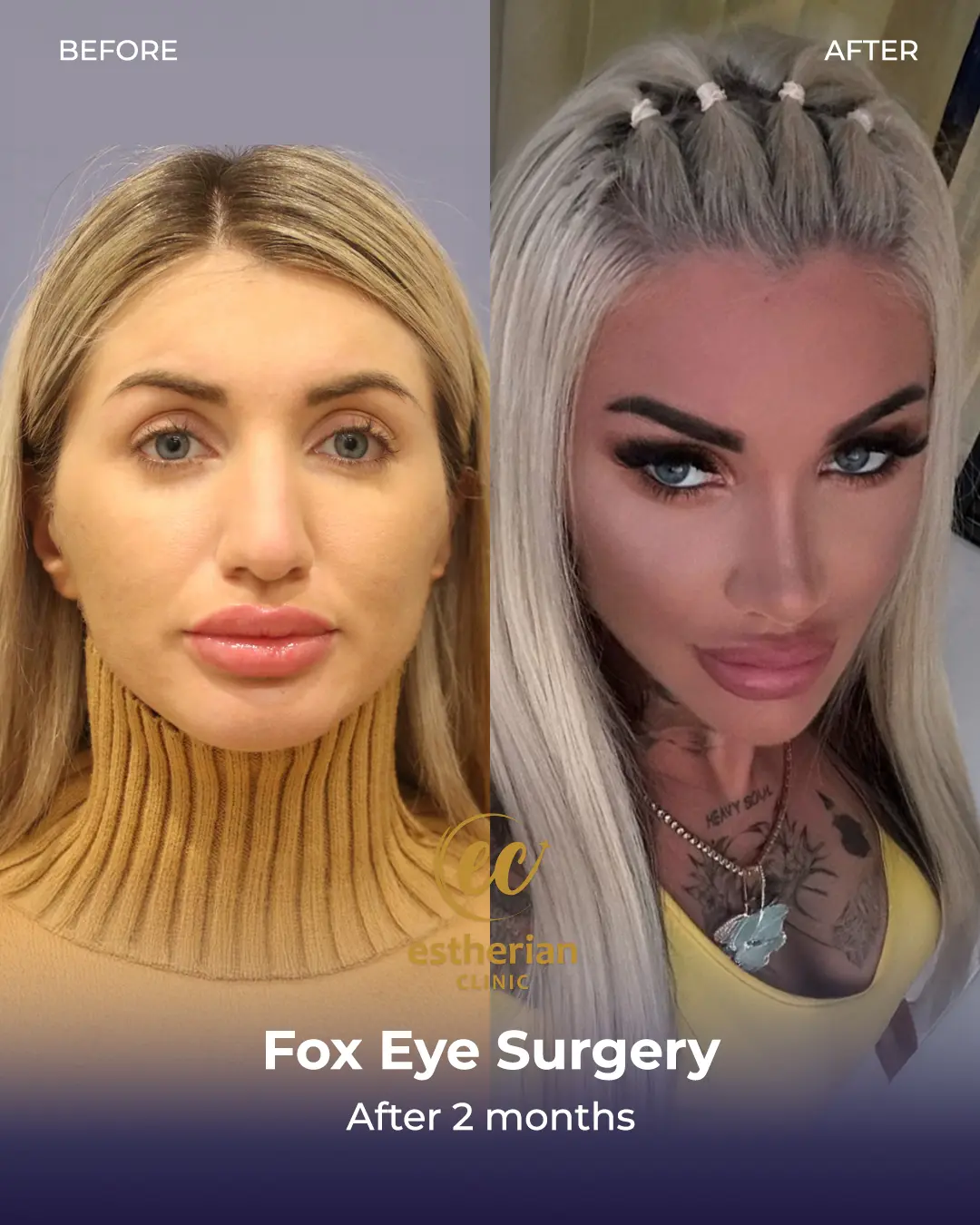 Fox Eye Surgery Results by the Estherian Clinic