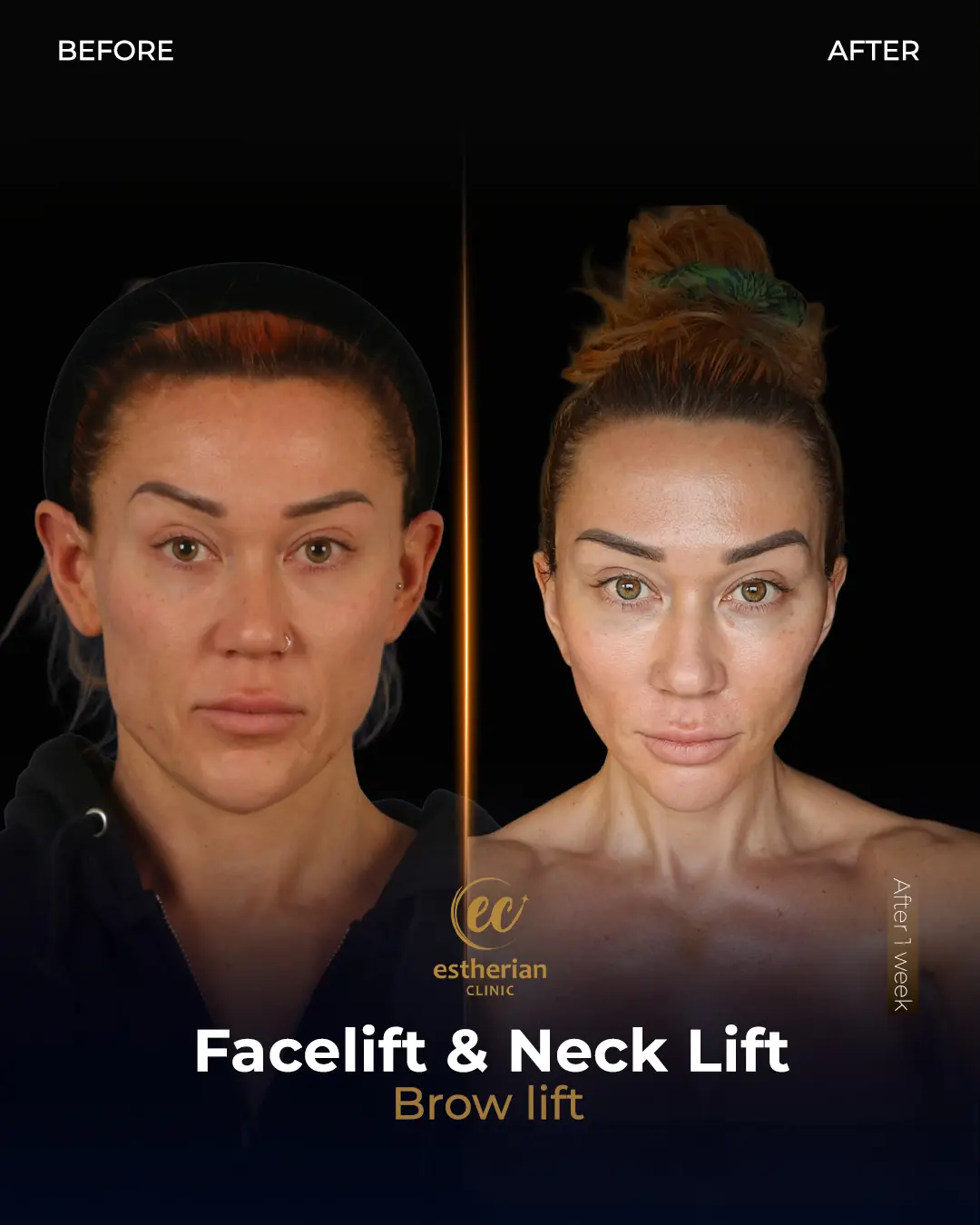 Face and Neck Lift Before and After Gallery by the Estherian Clinic