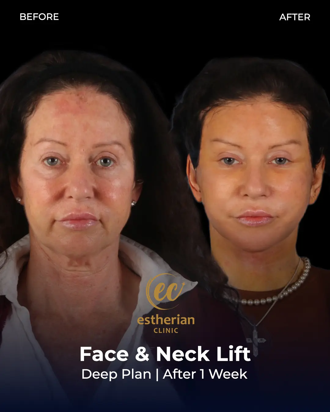 Face and Neck Lift Before and After Gallery by the Estherian Clinic