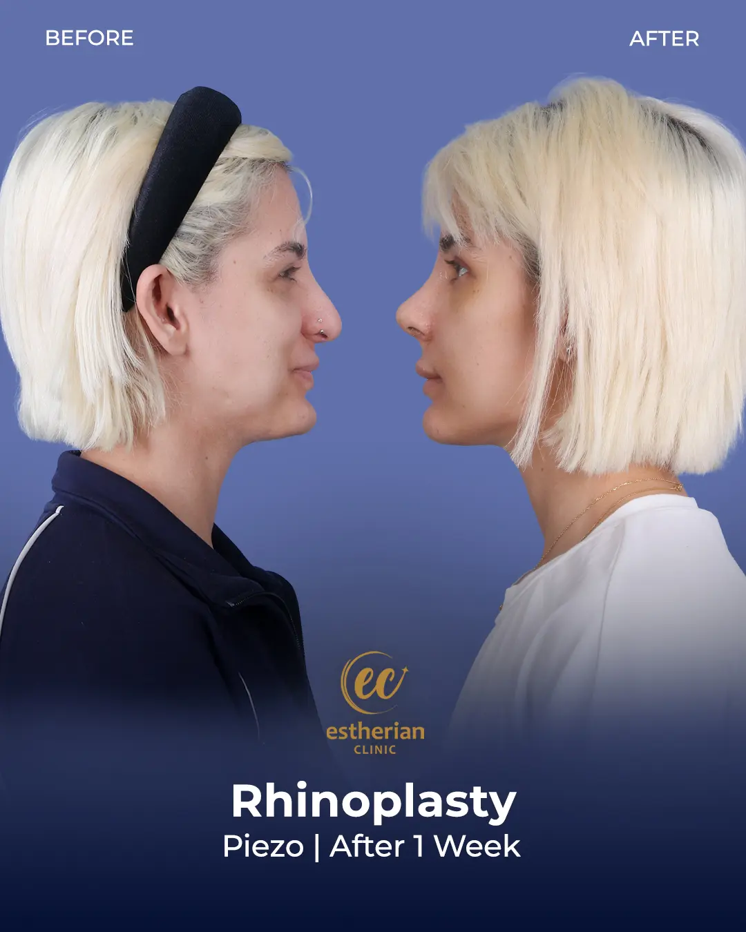 Rhinoplasty Before and After by the Estherian Clinic