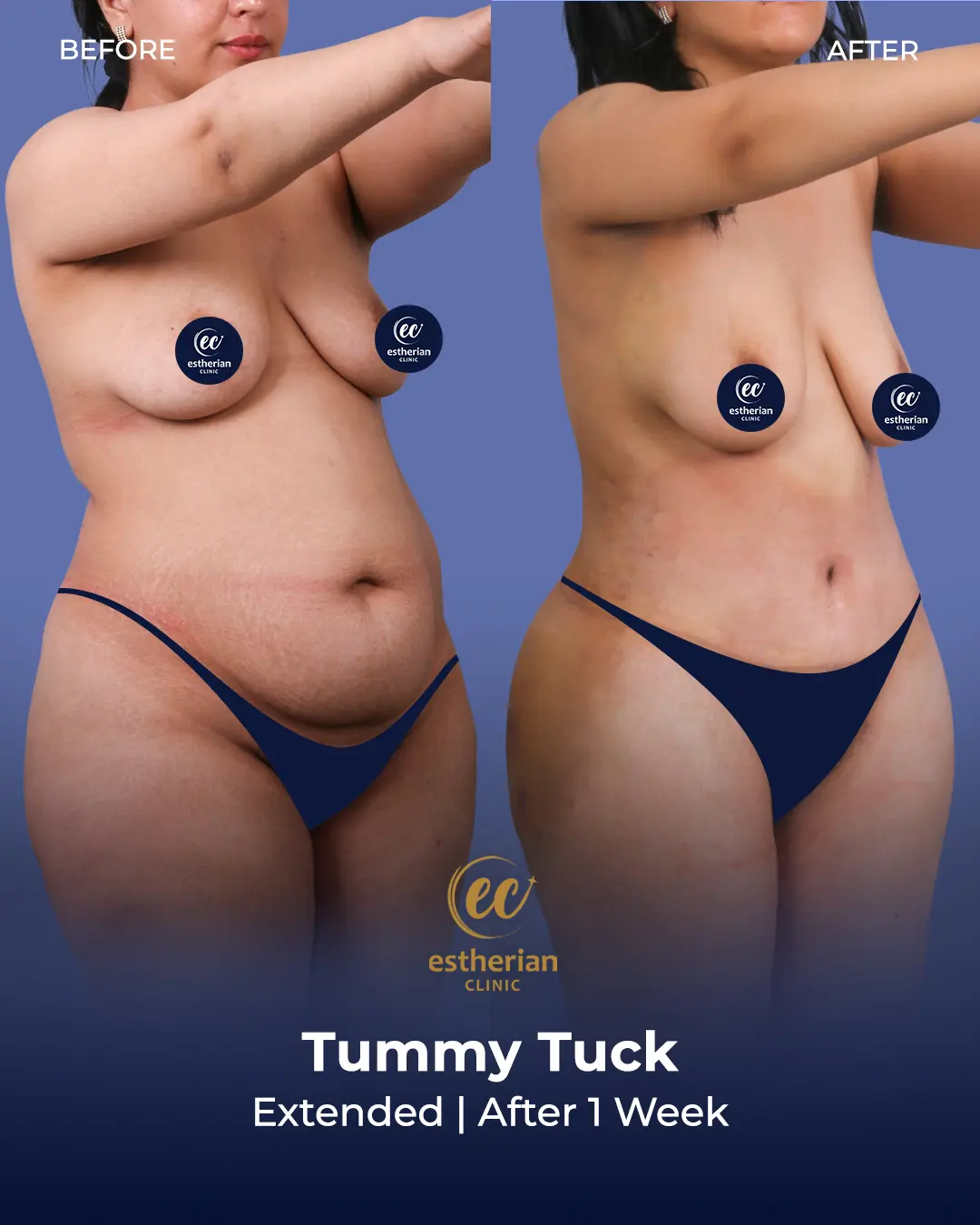 Tummy Tuck Before and after by the Estherian Clinic