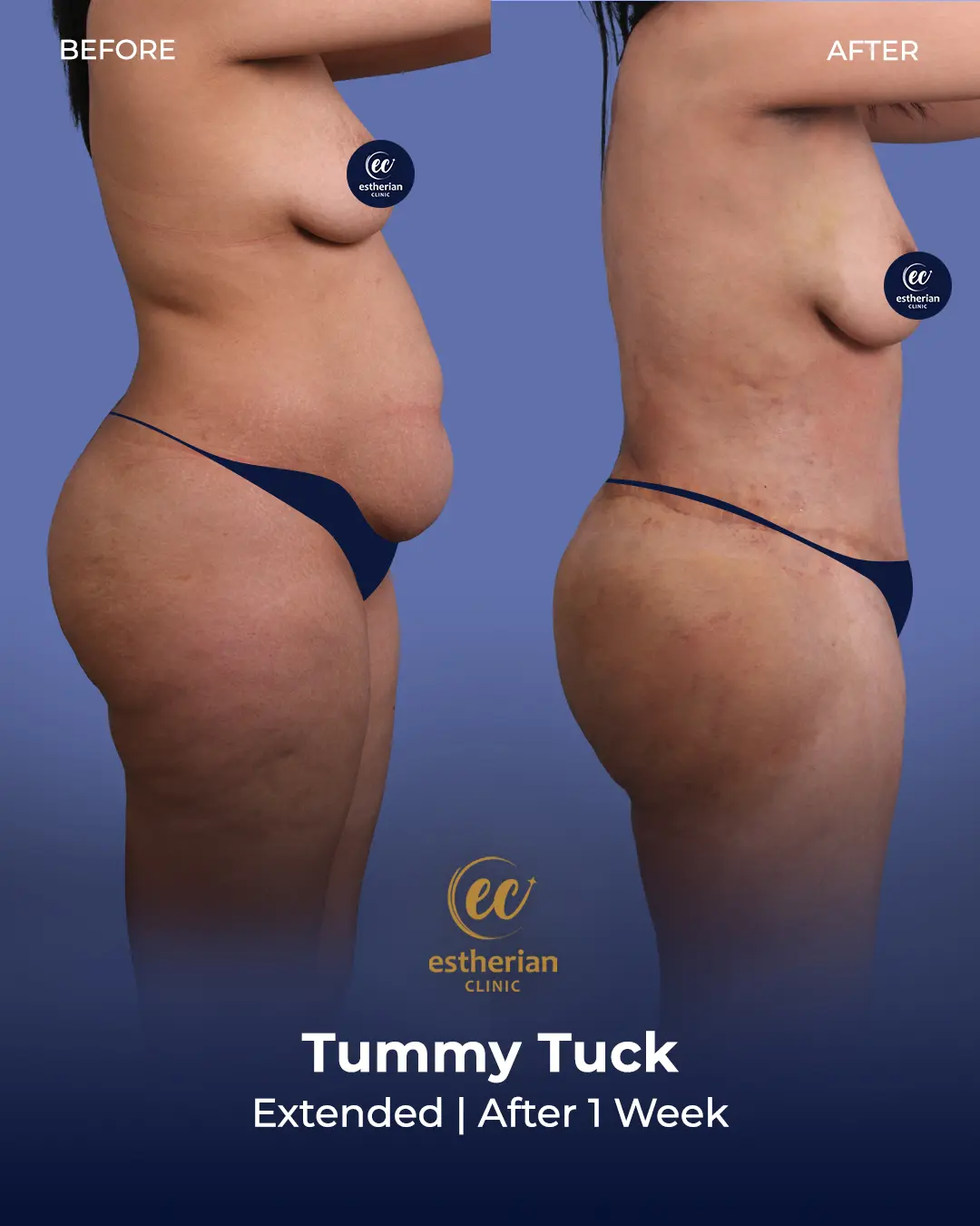 Tummy Tuck Before and after by the Estherian Clinic