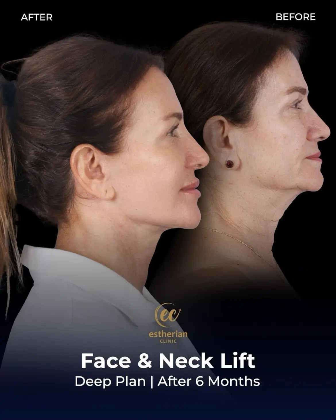Face and Neck Lift Before and After Gallery by the Estherian Clinic