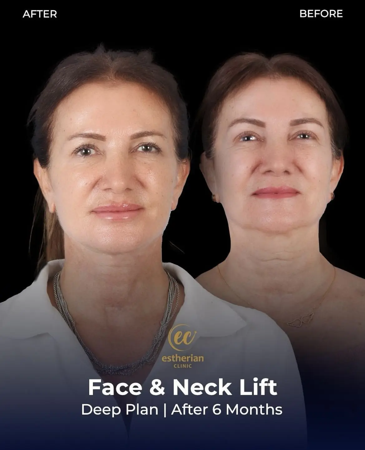 Face and Neck Lift Before and After Gallery by the Estherian Clinic
