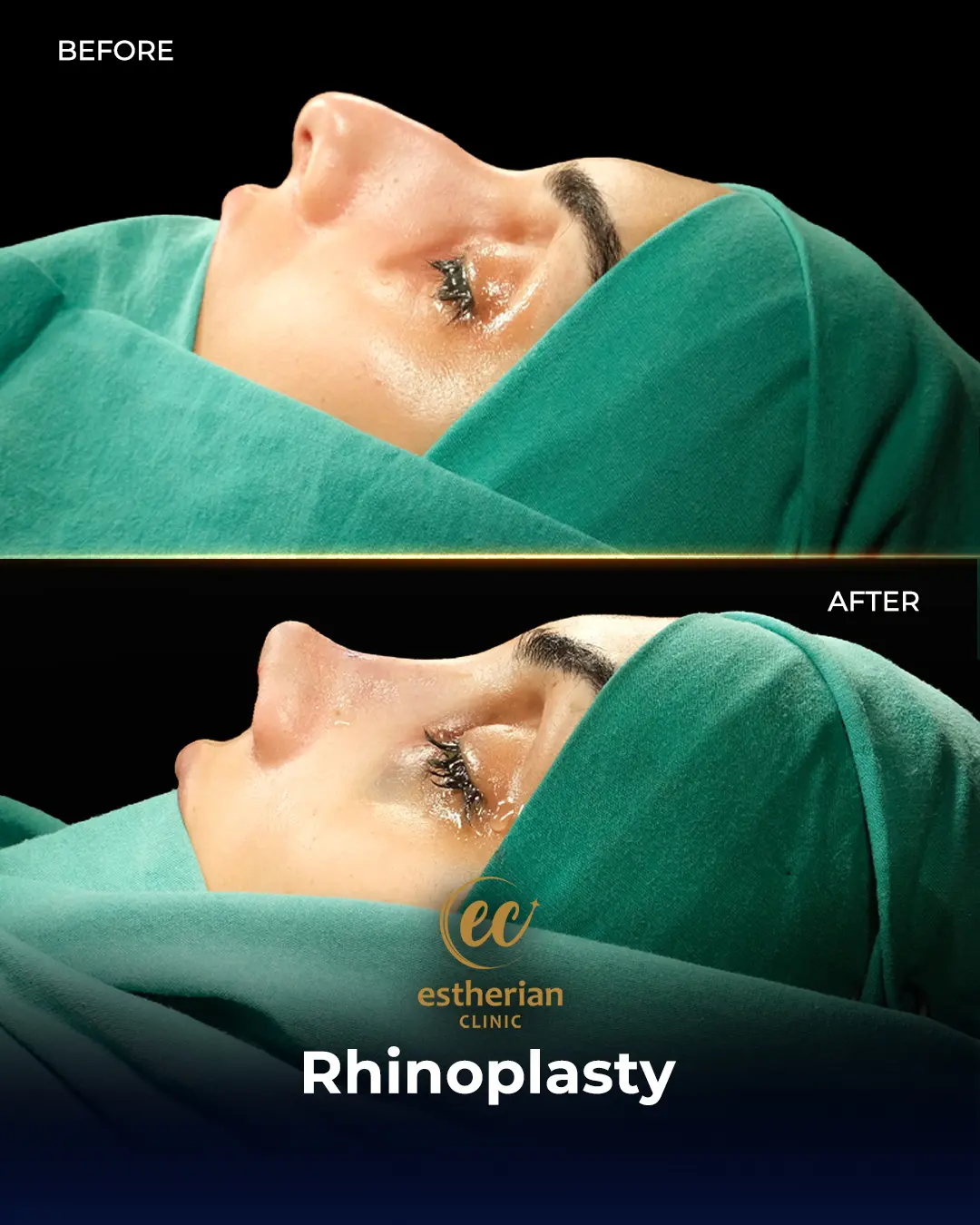 Rhinoplasty Before and After by the Estherian Clinic