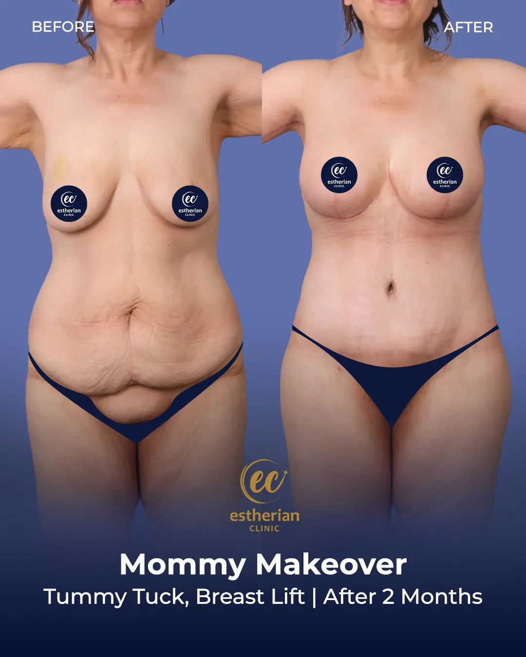 Body Contouring Surgery (before and after) by the Estherian Clinic