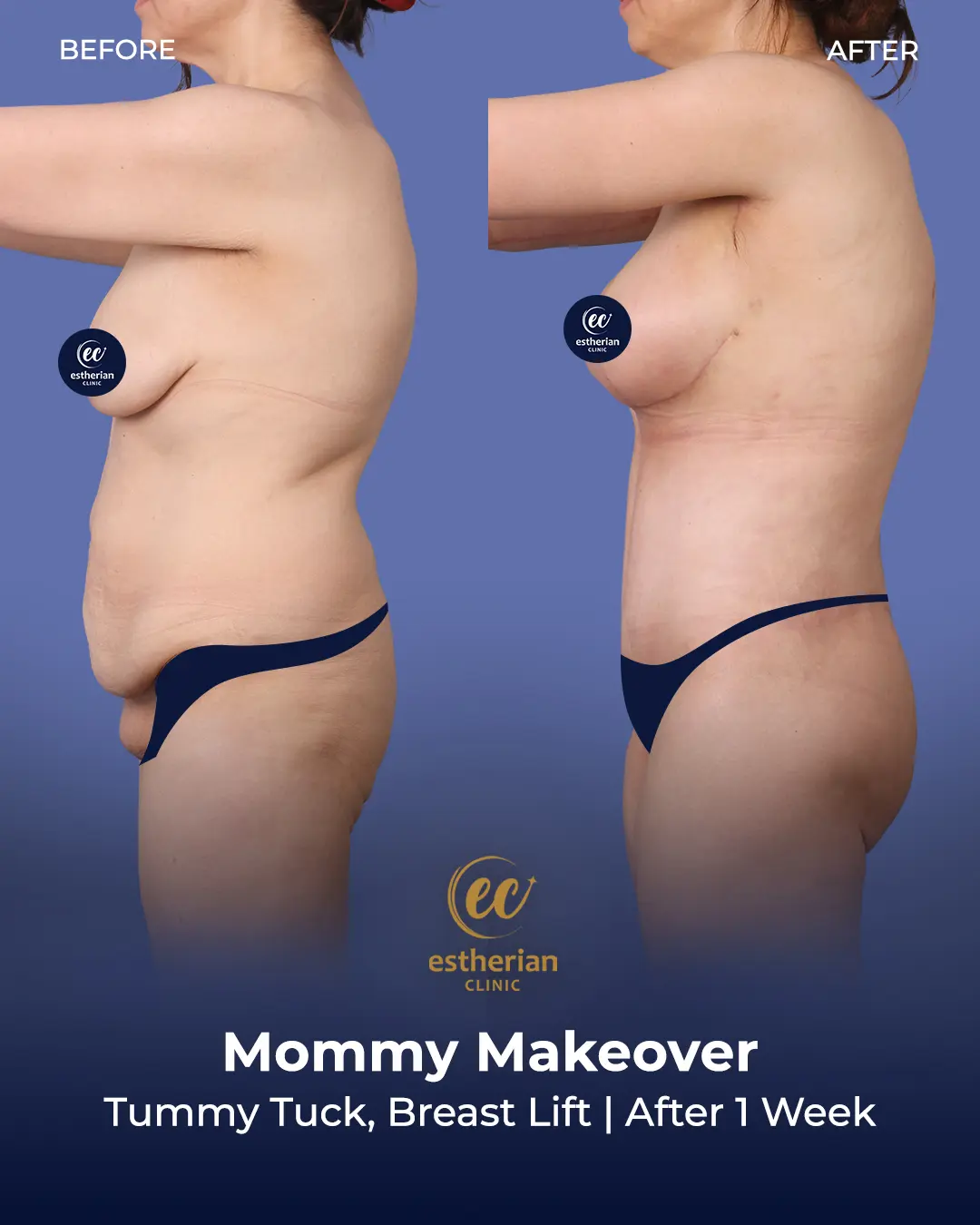 Body Contouring Surgery (before and after) by the Estherian Clinic