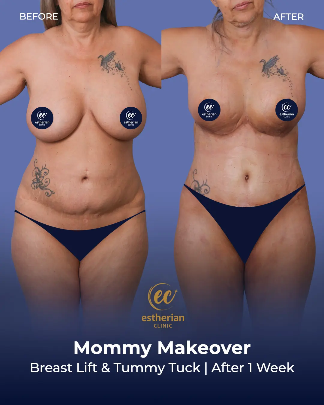 Body Contouring Surgery (before and after) by the Estherian Clinic