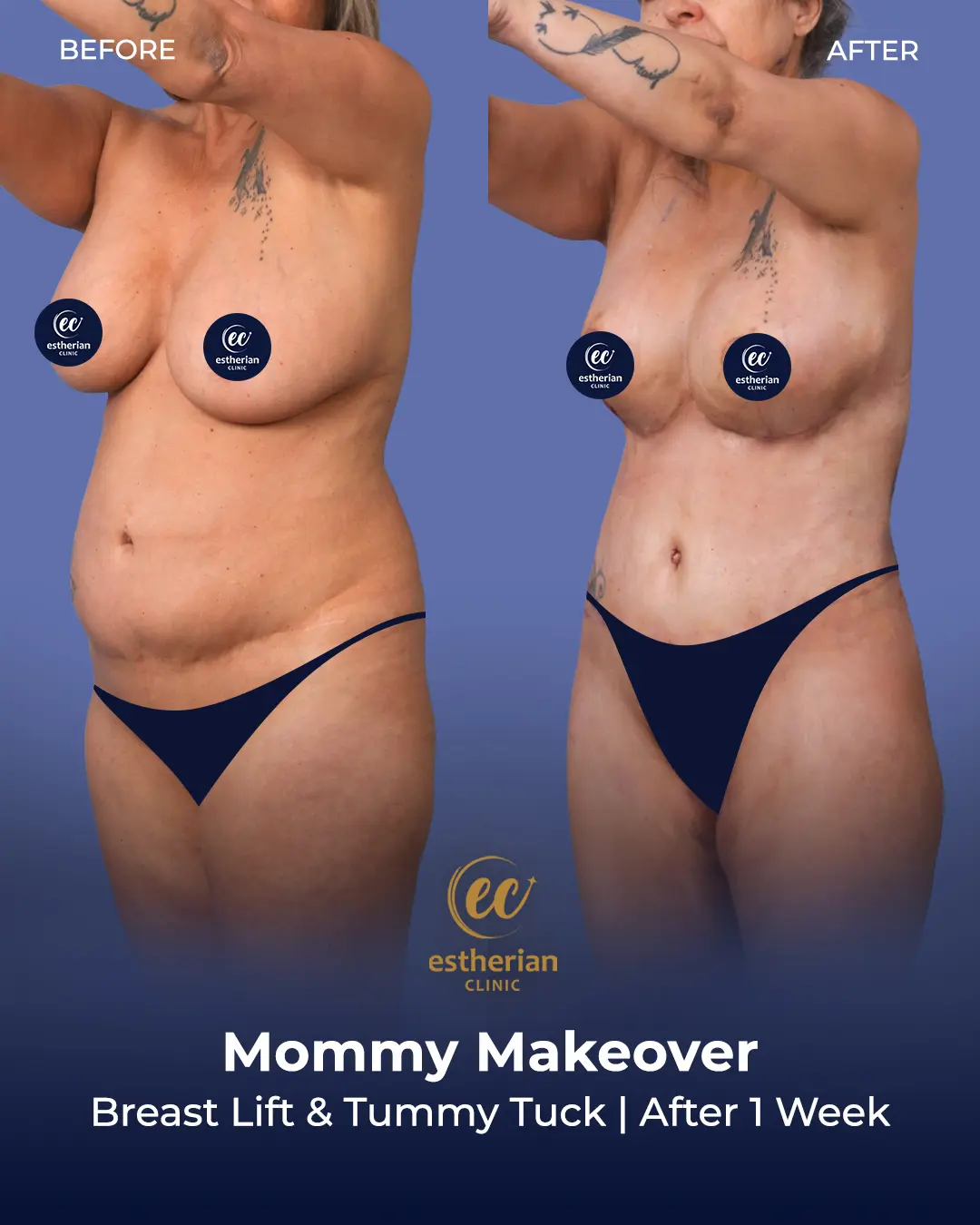 Body Contouring Surgery (before and after) by the Estherian Clinic